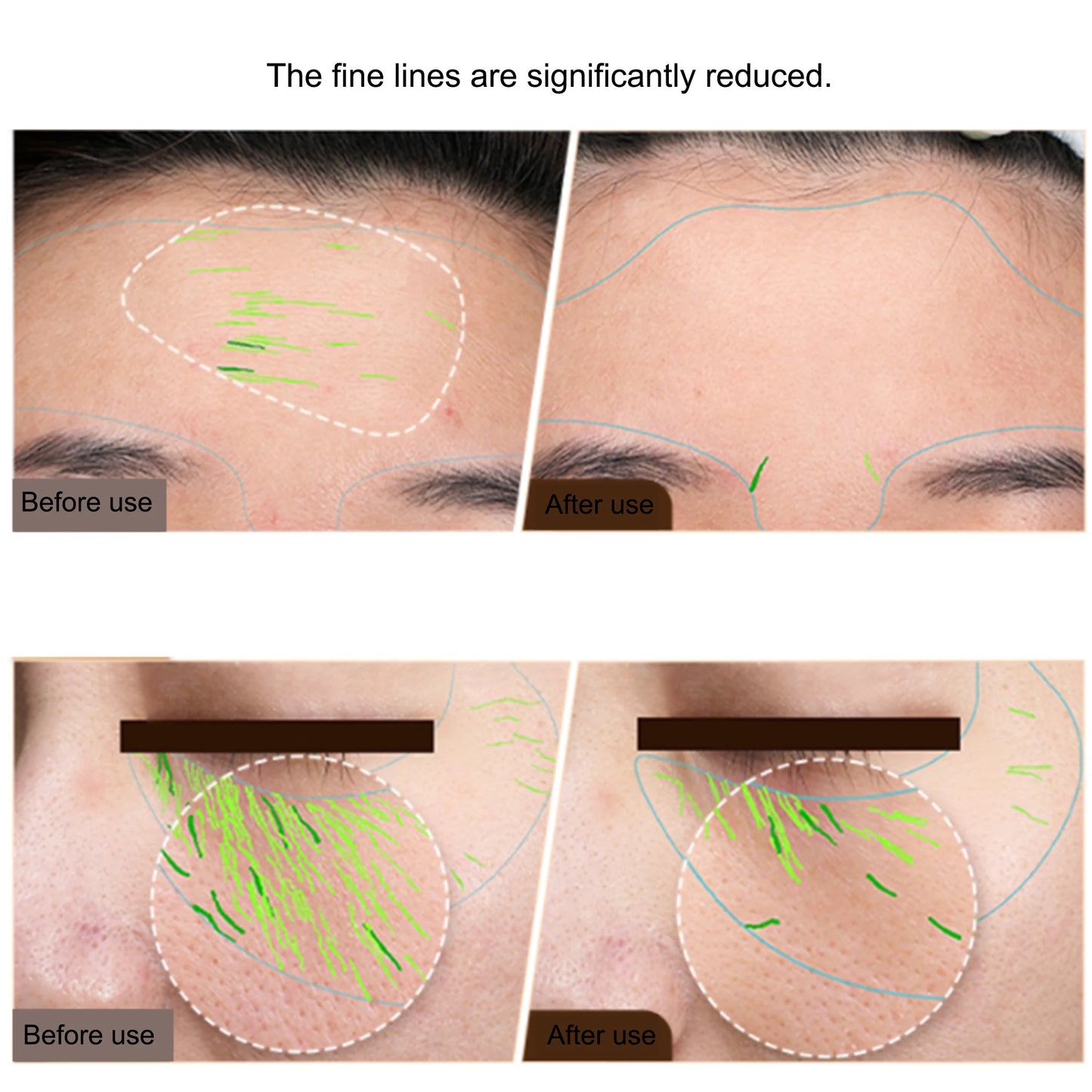 At-Home Skin Tightening & Face Lifting Device (RF + EMS)