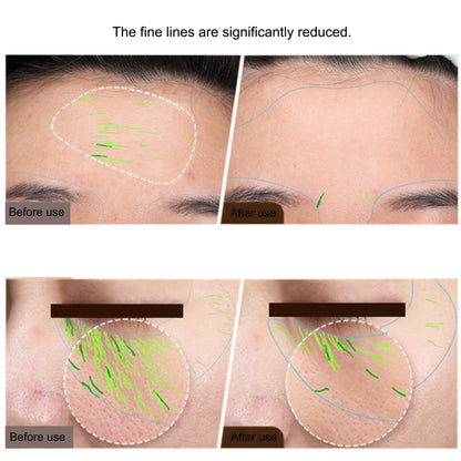 At-Home Skin Tightening & Face Lifting Device (RF + EMS)