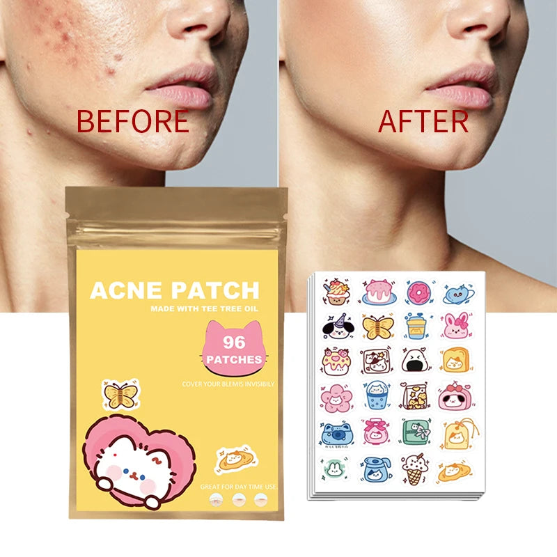 ClearCute Acne Patches – Cartoon Variety (96 Count)