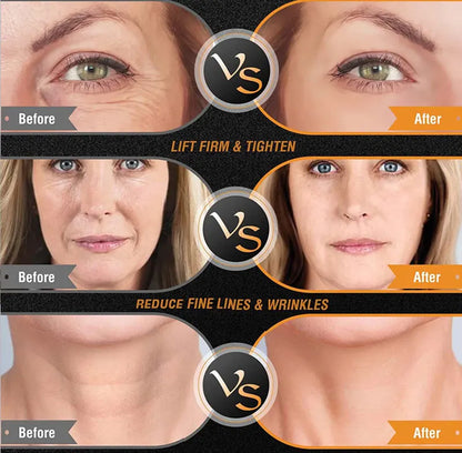 At-Home Skin Tightening & Face Lifting Device (RF + EMS)