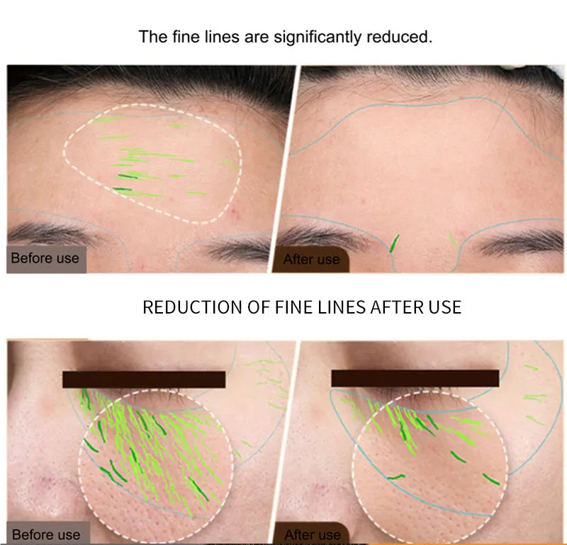 At-Home Skin Tightening & Face Lifting Device (RF + EMS)